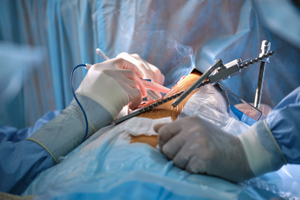 OTHER SURGICAL INST
